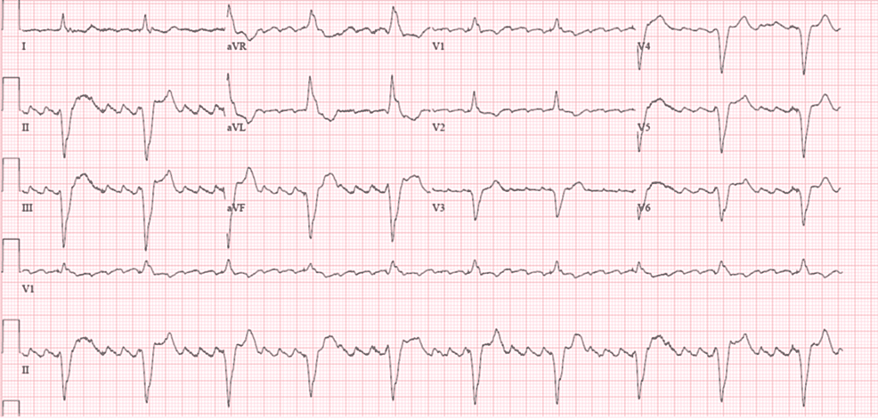 EKG-on-admission-showing-atrial-fibrillation-with-a-rapid-ventricular-response
