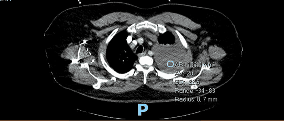 A-large,-left-sided-pleural-effusion-and-a-small-pericardial-effusion-seen-on-CT-chest