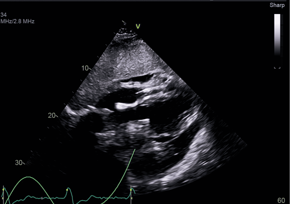-A-small-pericardial-effusion-and-apparent-diastolic-collapse-of-the-right-ventricle-seen-on-echocardiogram