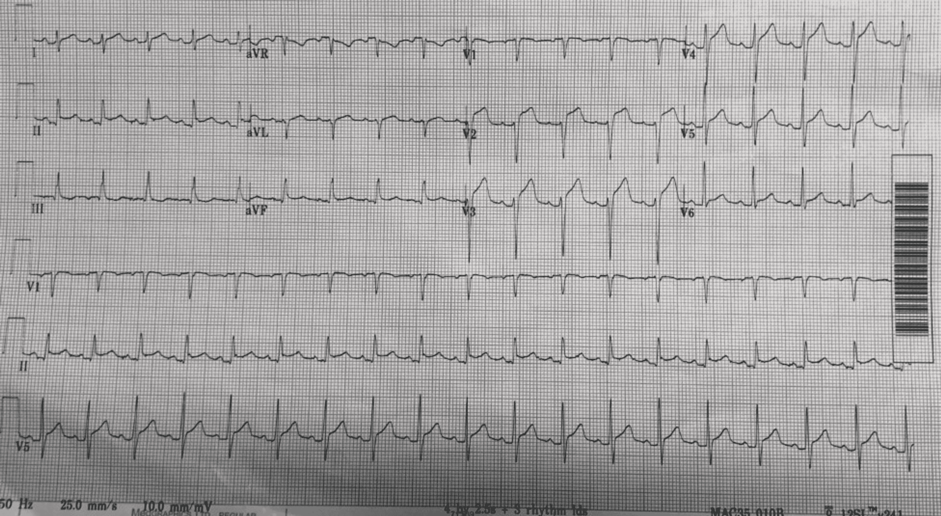 Cureus | A Case Report of Endoscopic Retrograde ...