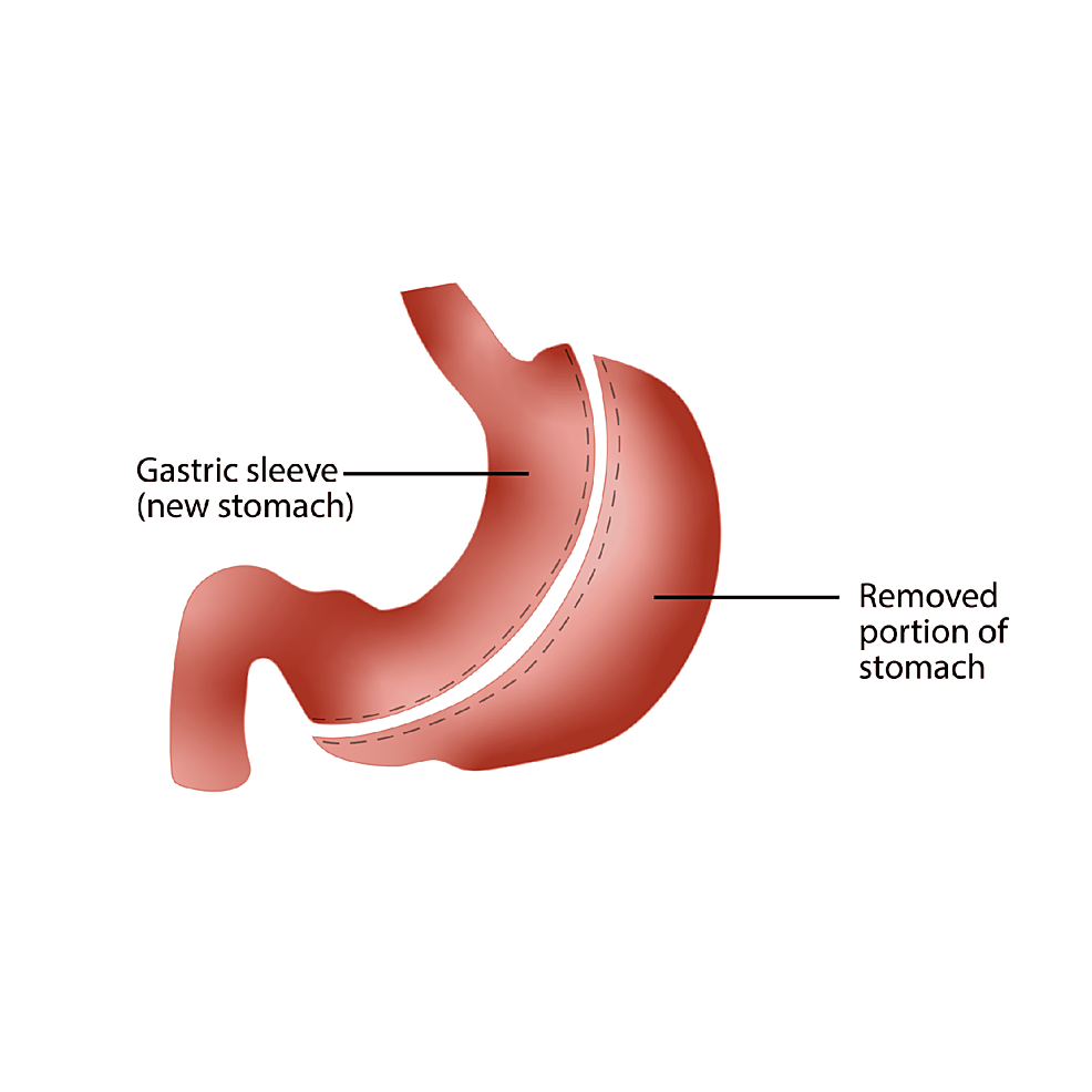 Cureus Bariatric Surgery With Roux En Y Gastric Bypass Or Sleeve Gastrectomy For Treatment Of