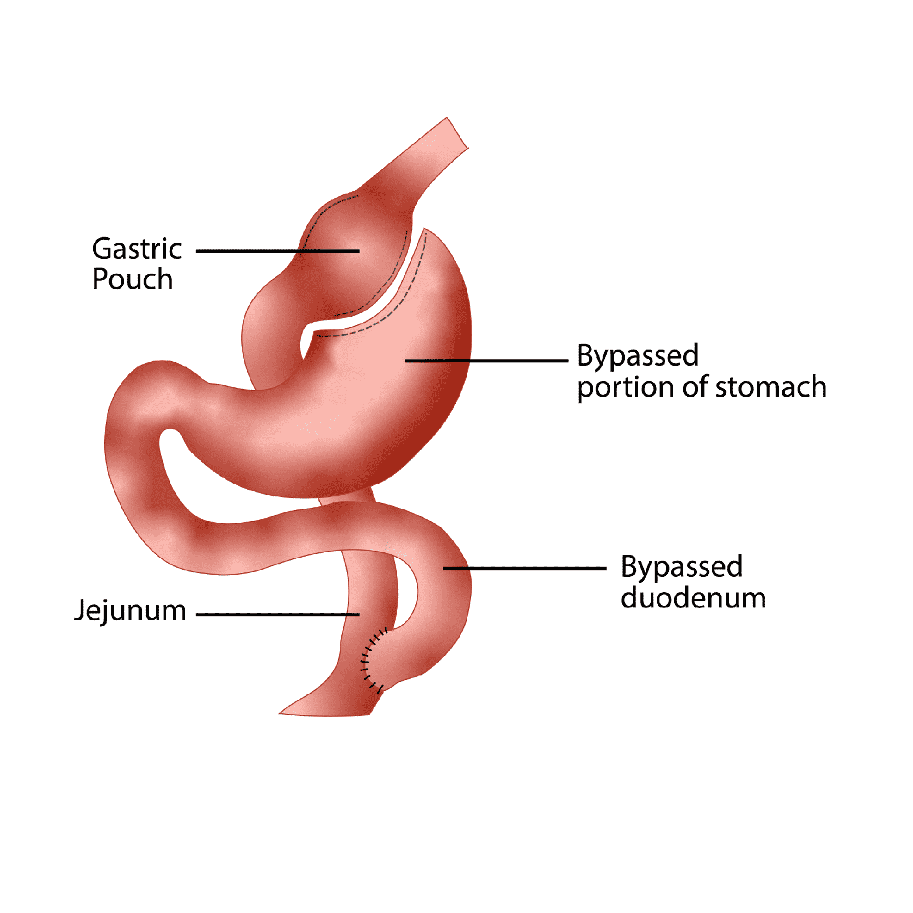 Cureus Bariatric Surgery With Roux En Y Gastric Bypass Or Sleeve Gastrectomy For Treatment Of