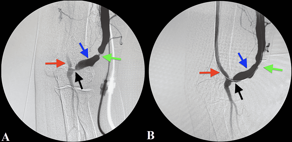 cureus-an-arterial-anastomosis-stenosis-used-in-lieu-of-banding-to