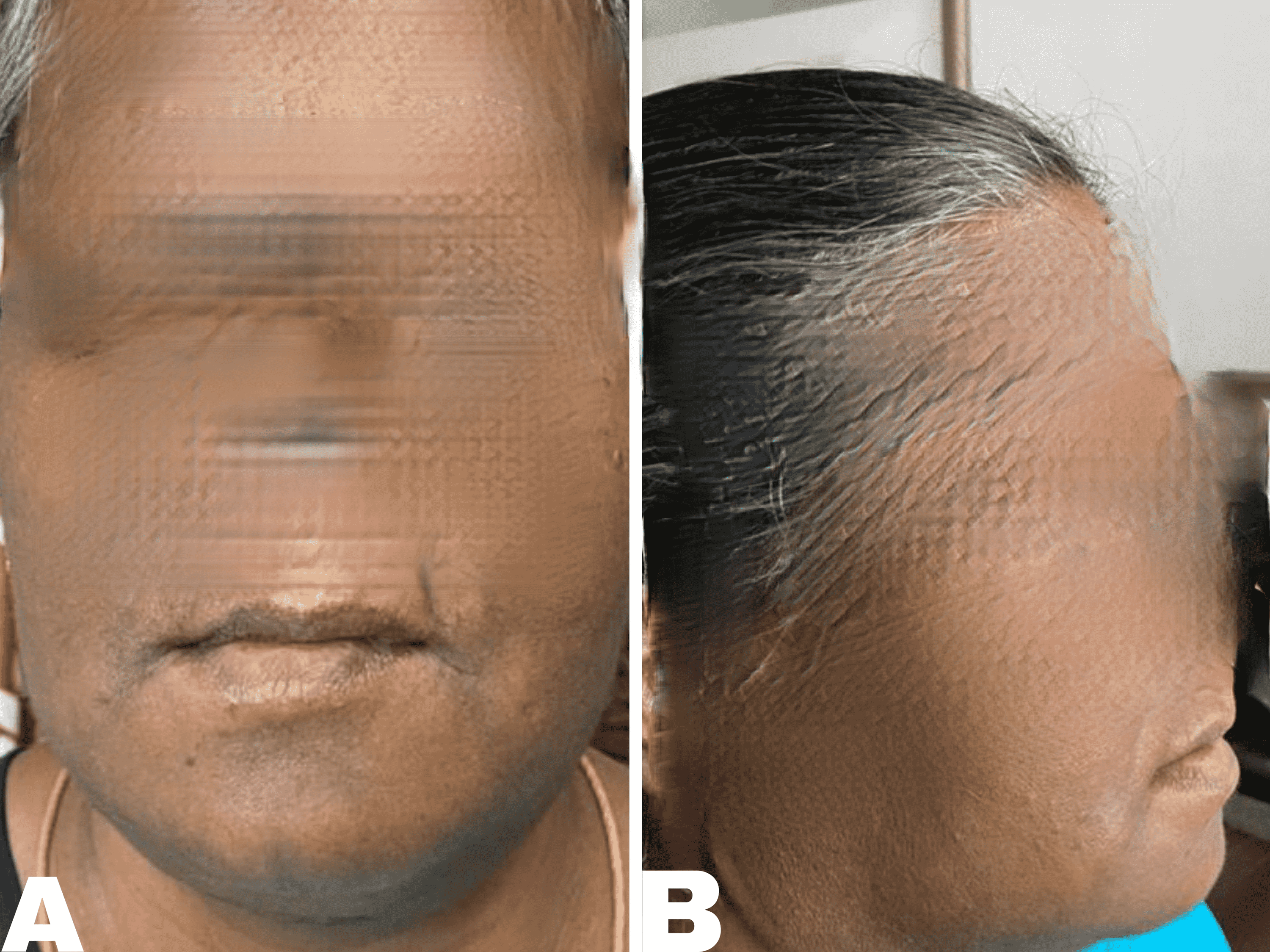 Intraosseous Mucoepidermoid Carcinoma Of The Anterior Mandible: A Case ...