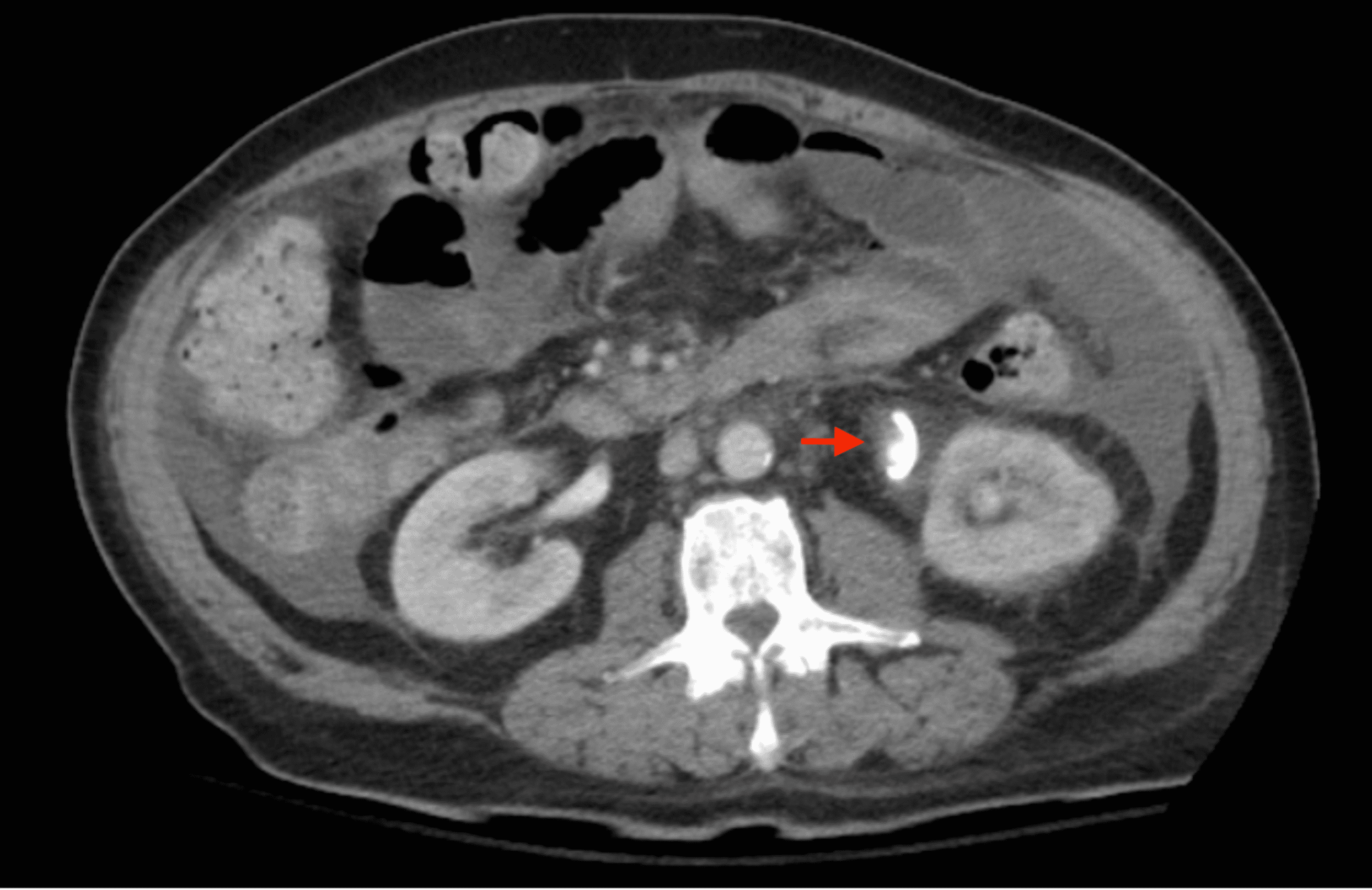 Cureus | Arterioureteral Fistula in the Setting of Radical ...