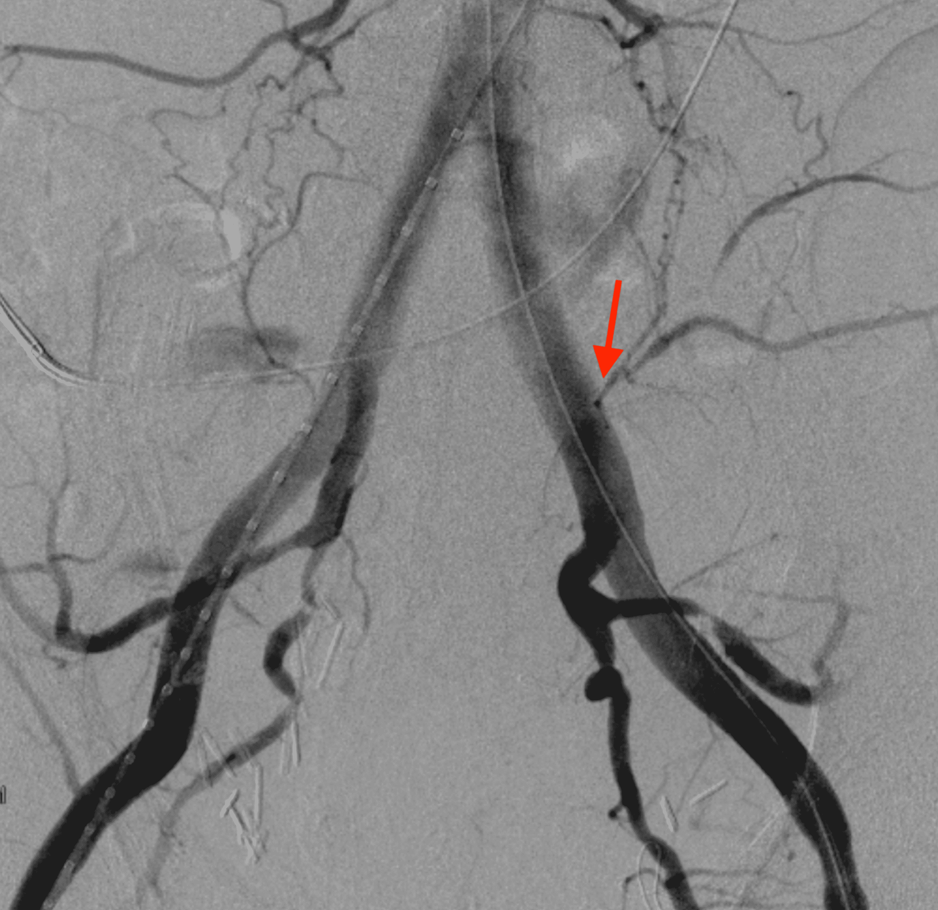 Cureus Arterioureteral Fistula in the Setting of Radical