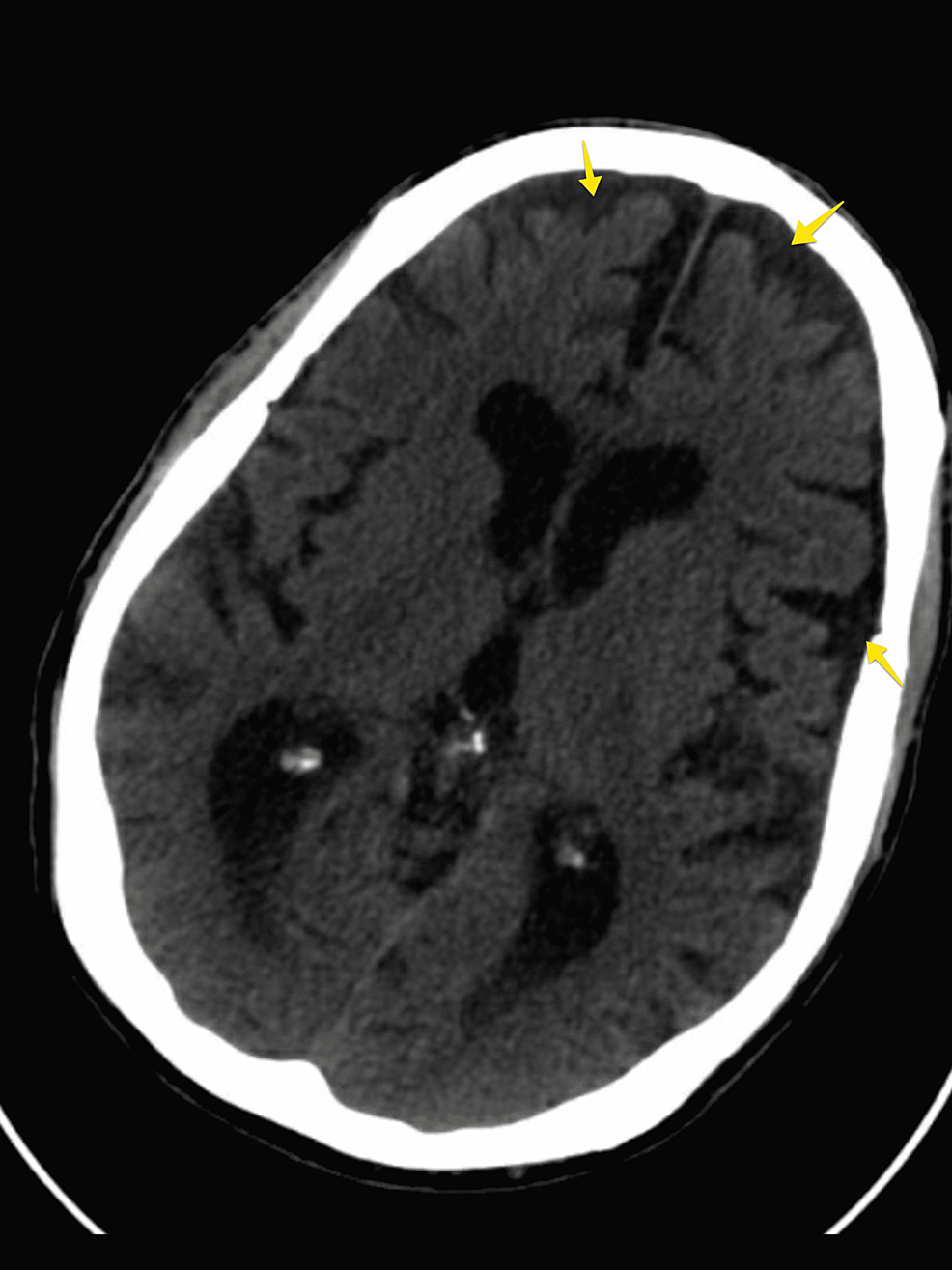 A-non-contrast-CT-scan-with-arrows-highlighting-evident-cerebral-atrophy-of-the-frontal-and-temporal-regions.