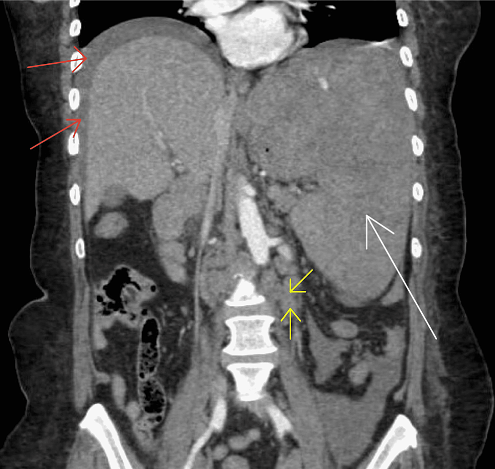 Cureus Mantle Cell Lymphoma With Non traumatic Splenic Rupture