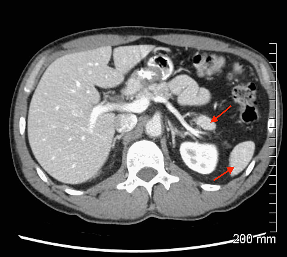 Cureus | Accessory Spleen Masquerading as an Intrapancreatic Tumor: A ...
