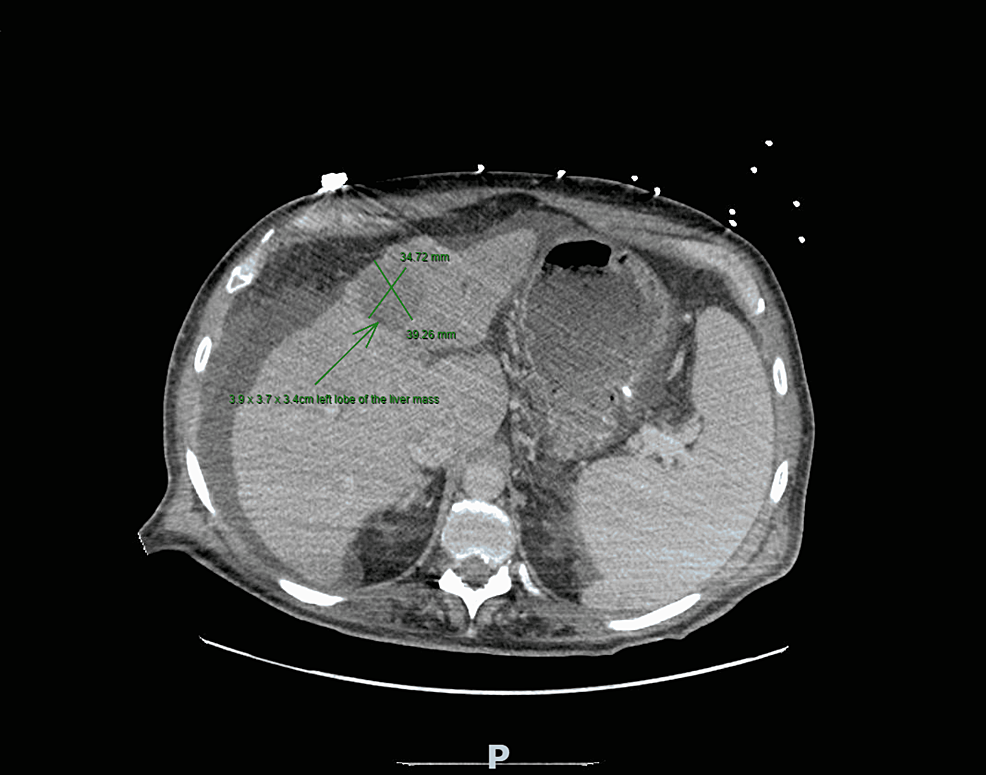 CT-scan-of-abdomen-showing-a-3.9-×-3.7-×-3.4-cm-left-lobe-of-liver-mass.