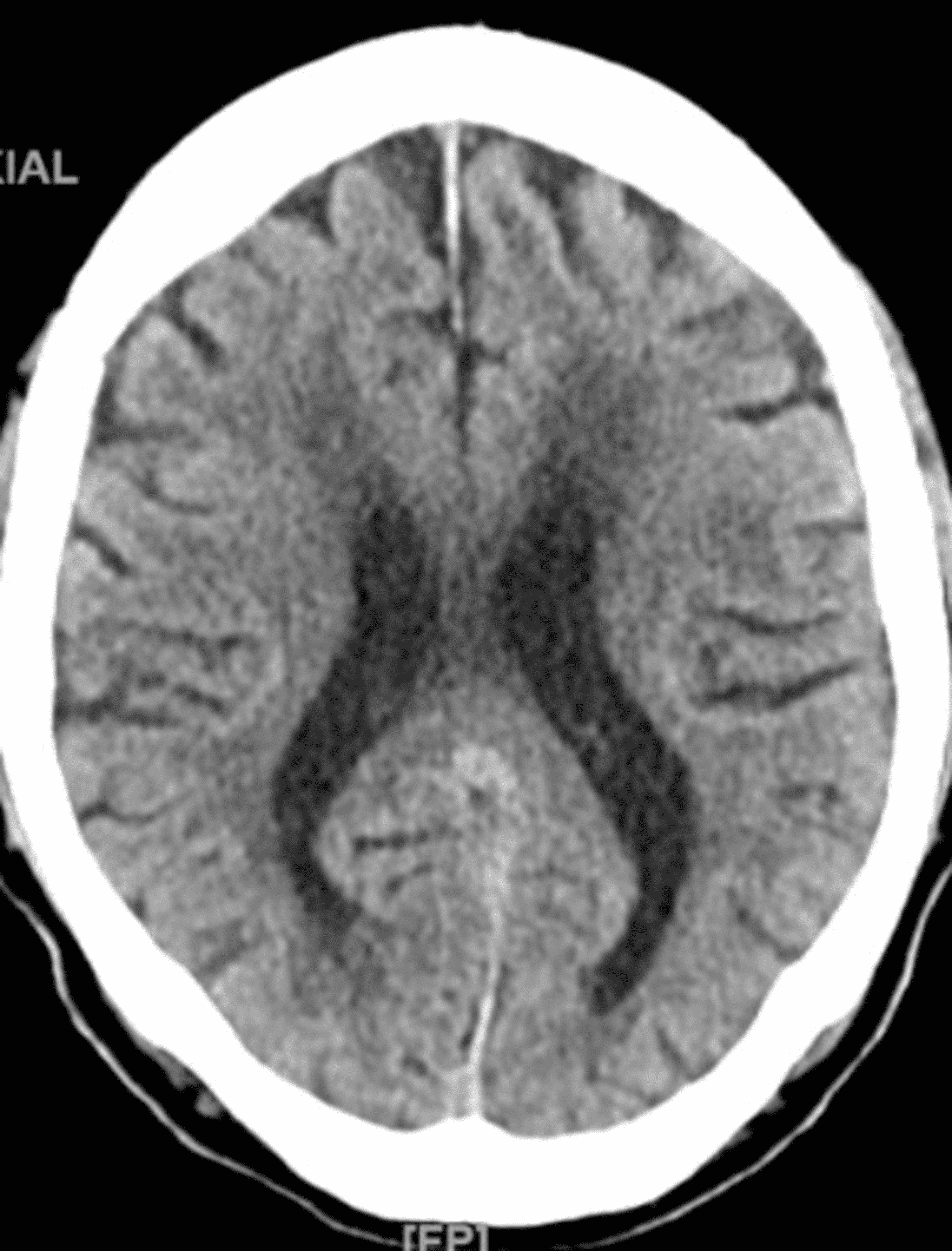 Cureus | Dialysis Disequilibrium Syndrome: A Red Flag to Check Post ...