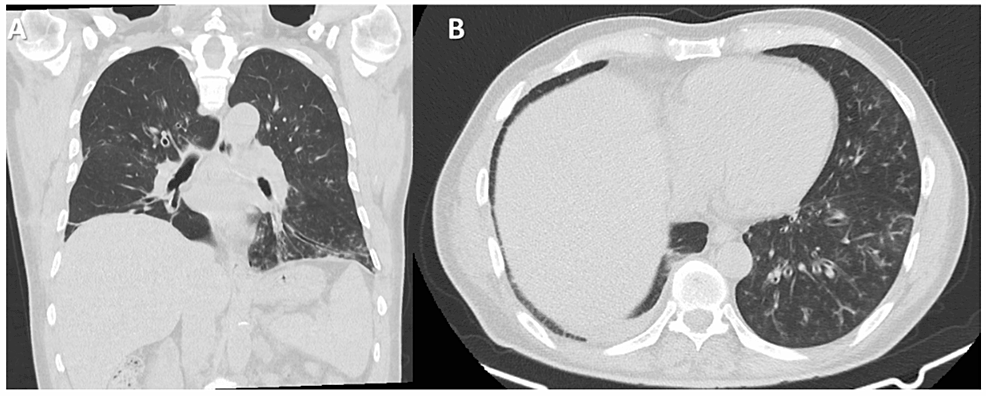 (A-and-B)-Coronal-and-axial-chest-CT-show-centrilobular-ground-glass-nodules,-tree-in-buds,-and-thickened-airways-mainly-at-the-left-lower-lung-lobes.