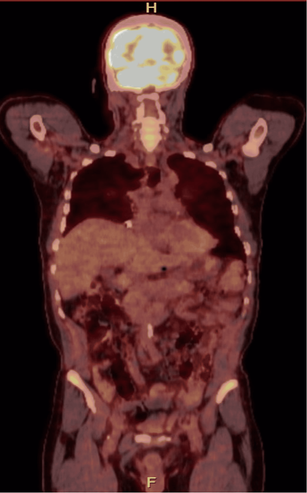 Coronal-section-of-PET-CT-scan-showing-small-right-lower-lobe-0.6-cm-nodule-with-SUVmax-1.3.-The-described-diffusely-increased-FDG-activity-of-the-bone-marrow-is-seen-in-the-iliac-bone.