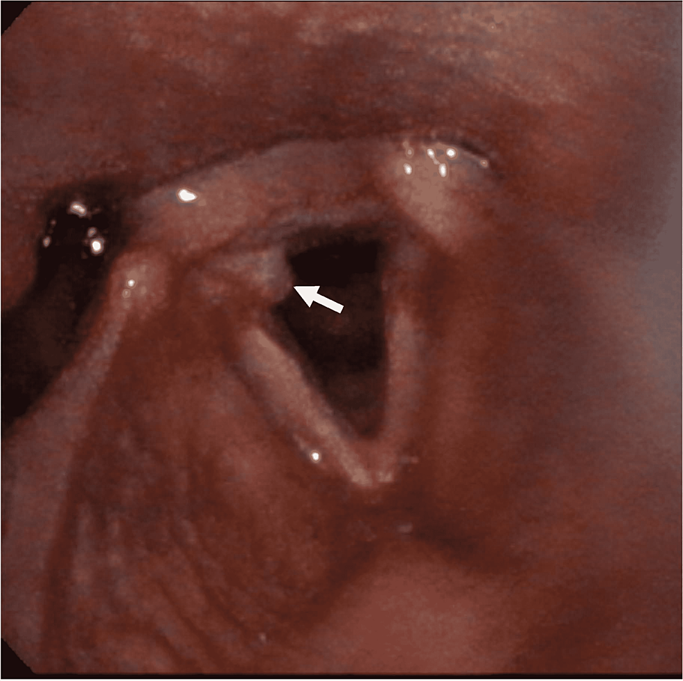 Granuloma-of-the-right-vocal-fold