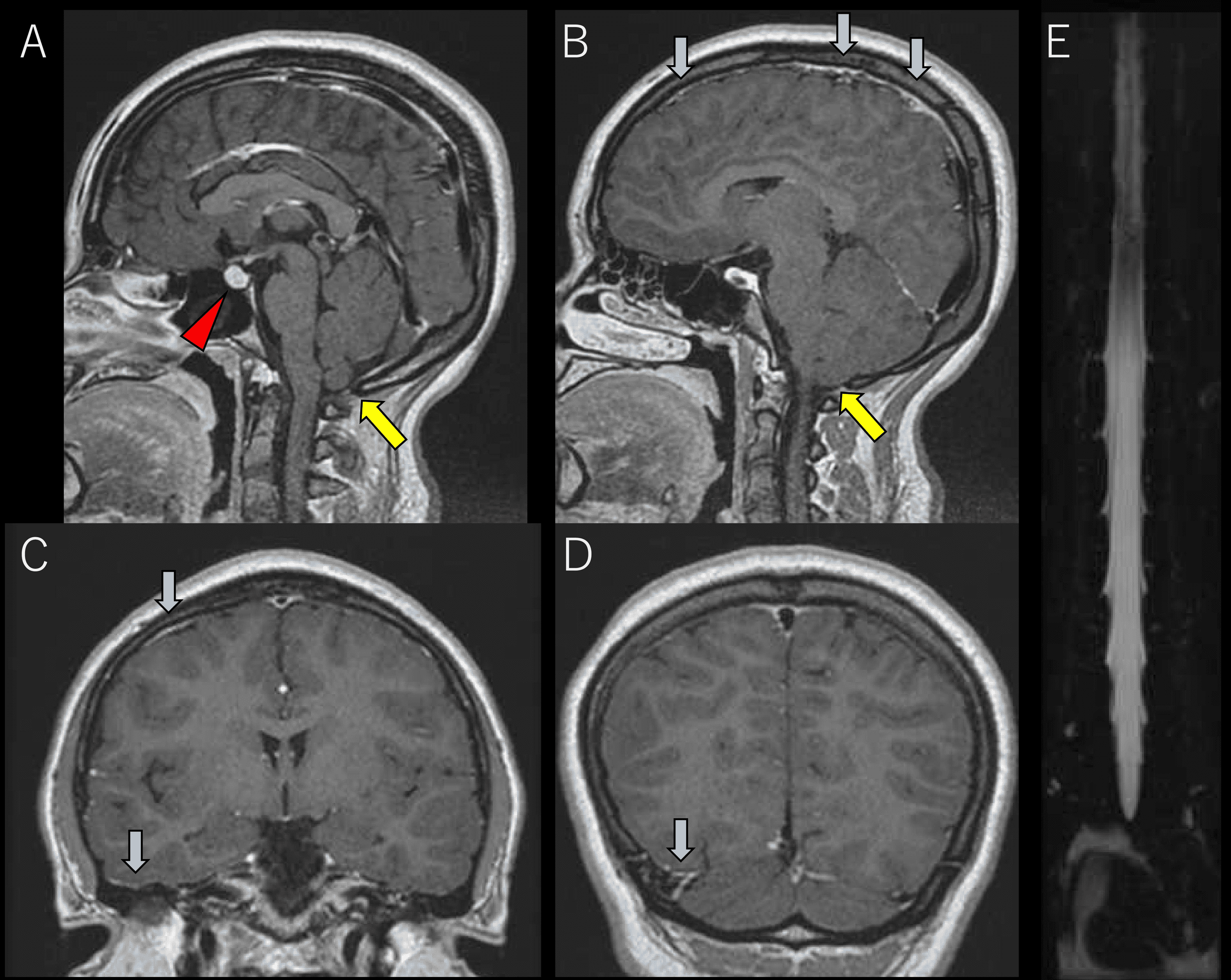 Cureus | Spontaneous Intracranial Hypotension Manifesting Orthostatic ...