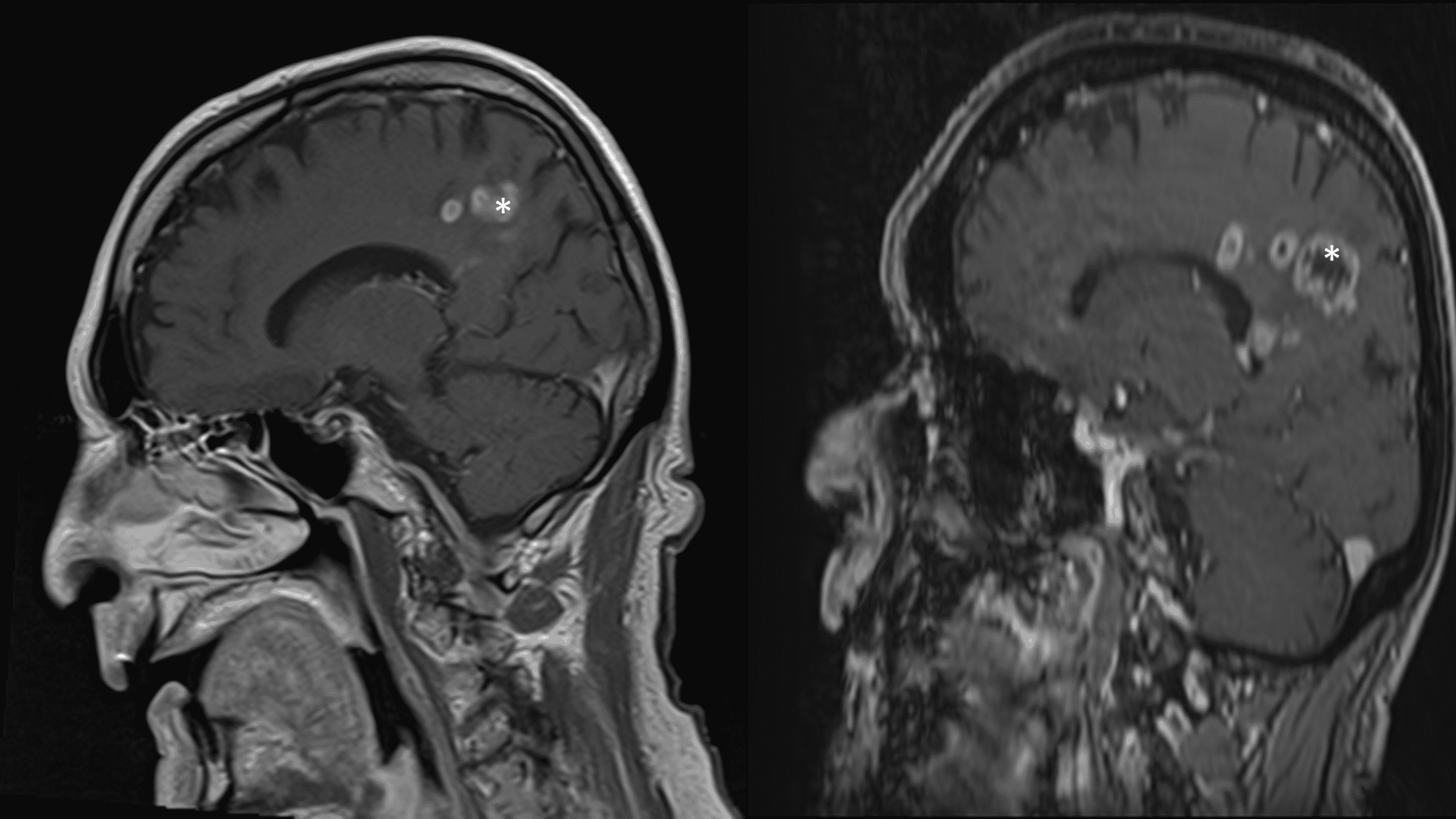 comparative-quantification-of-diffusion-tensor-tractography-using