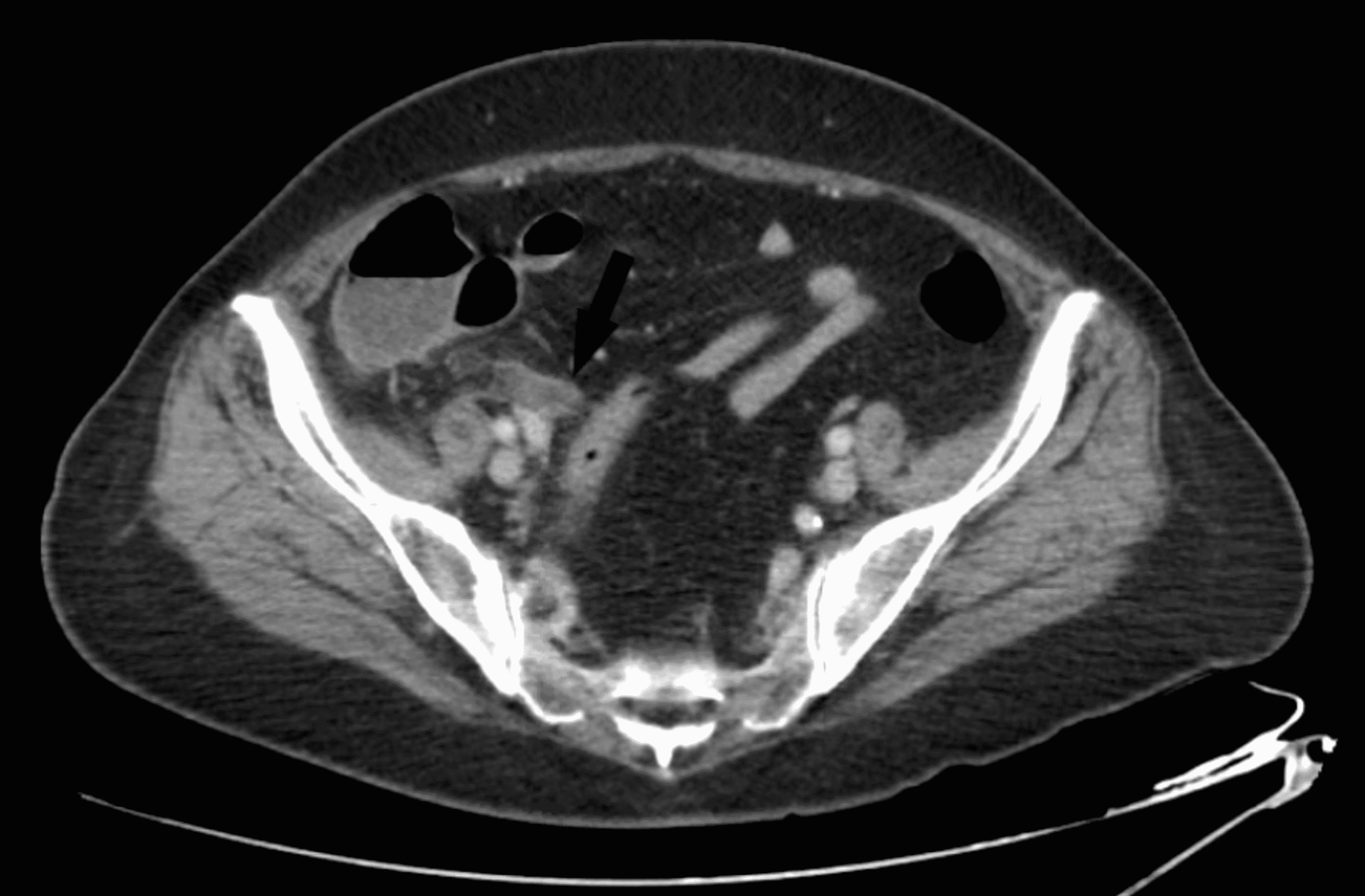 Cureus | Complicated Severe Appendicitis in a 58-Year-Old Female After ...