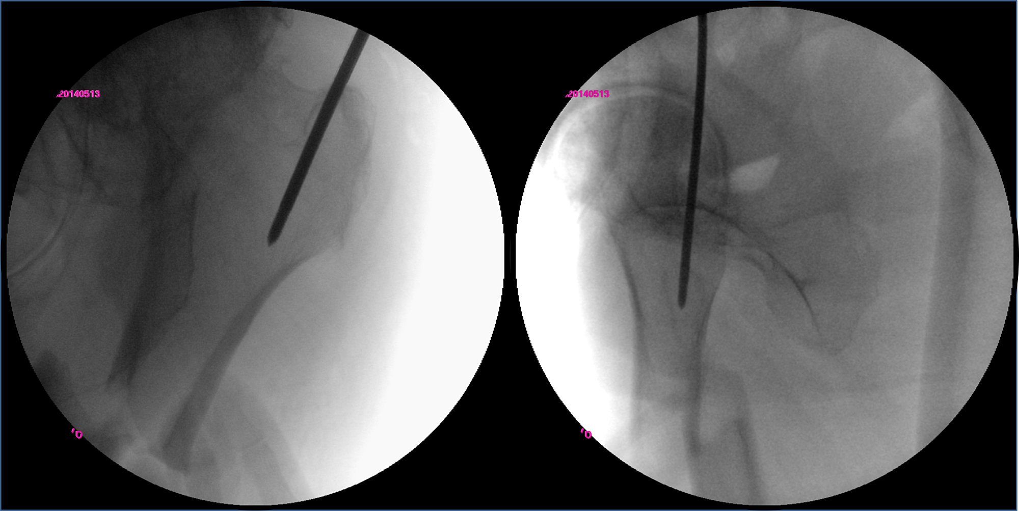 Cureus | Subtrochanteric Fracture of the Femur Accompanying Pre-existing  Ipsilateral Osteoarthritis of the Hip Successfully Treated with Intramedullary  Nailing in the Lateral Decubitus Position: A Case Report | Article