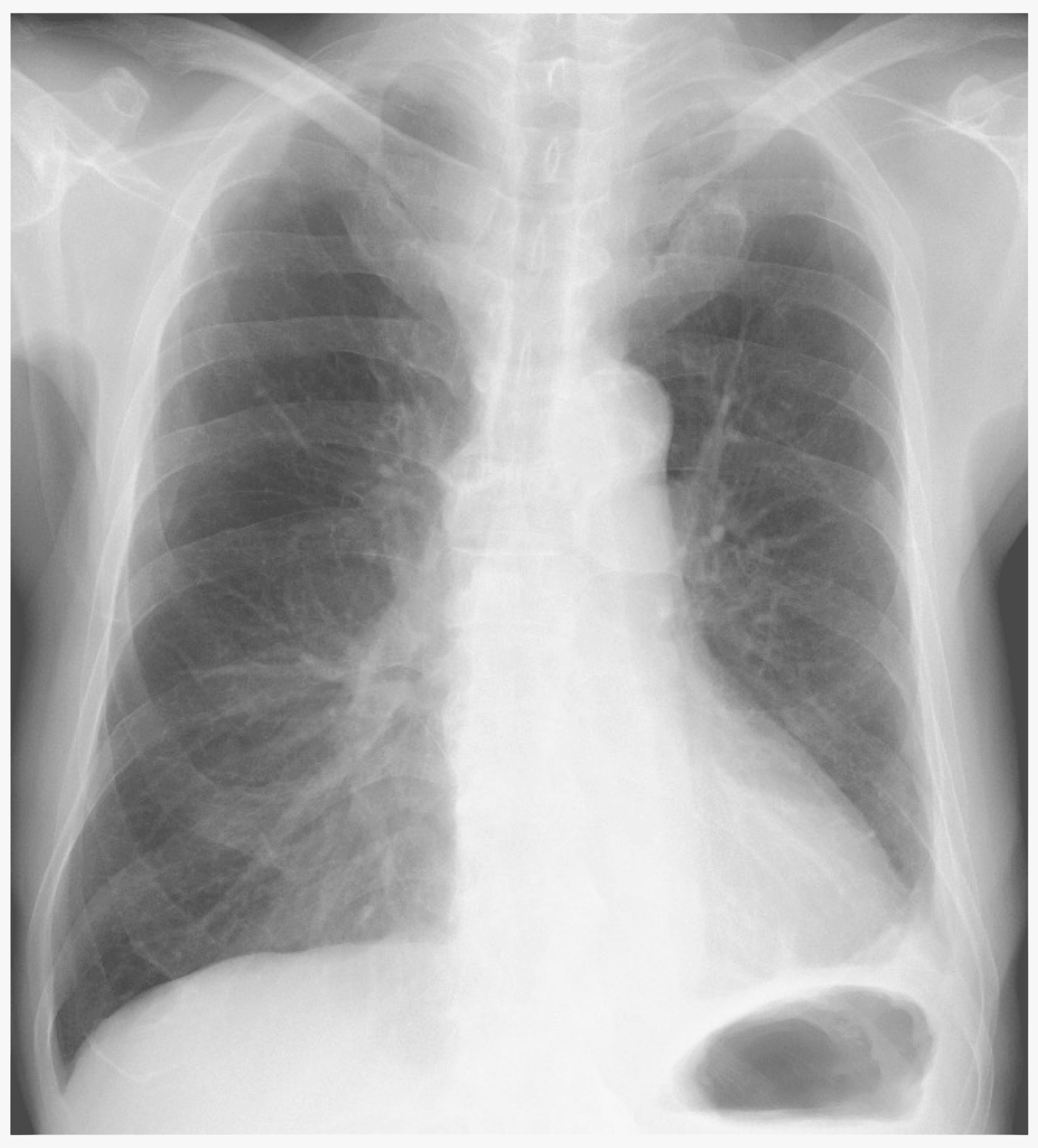 Successful VideoAssisted Thoracoscopic Removal of a Chest Tube