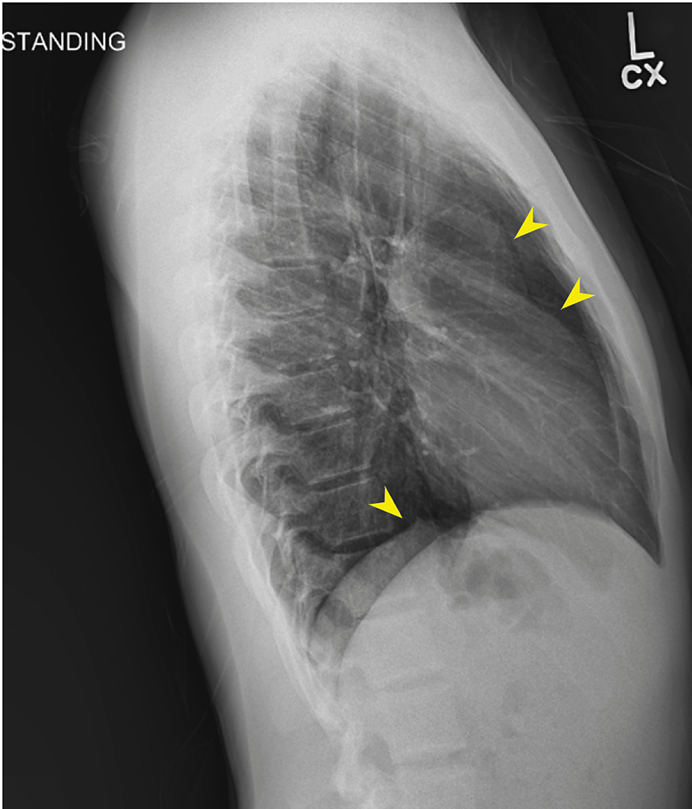 Lateral-chest-X-ray