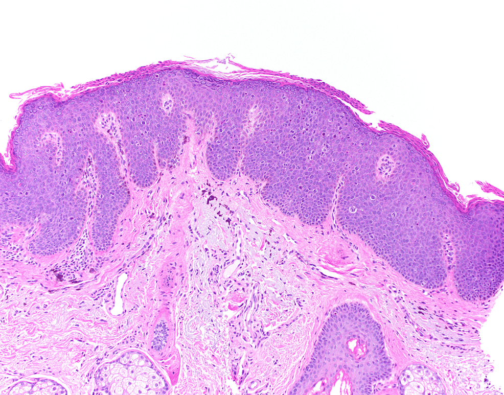 Cureus | A Rare Presentation of Extragenital Bowenoid Papulosis