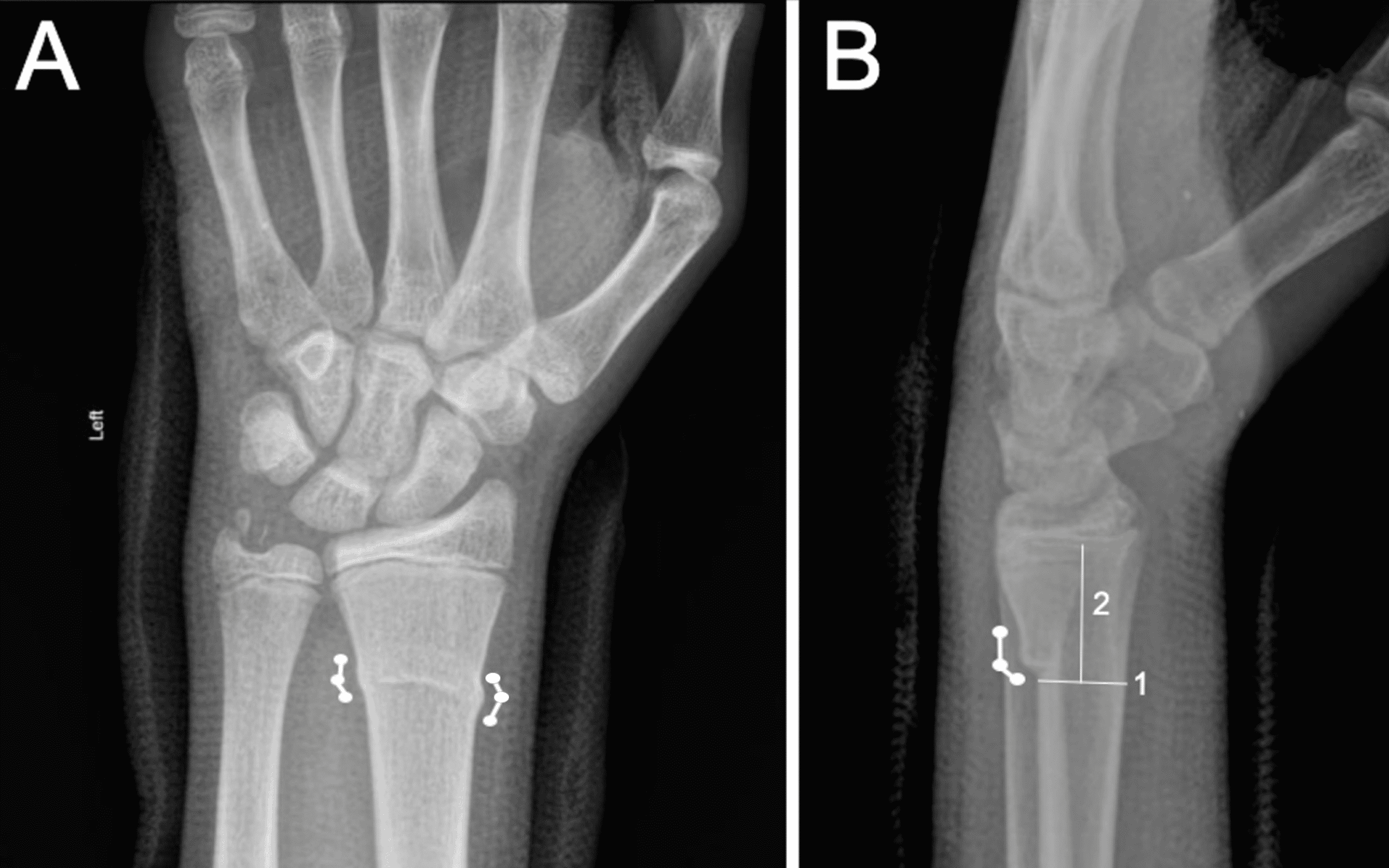 buckle fracture wrist 2 year old