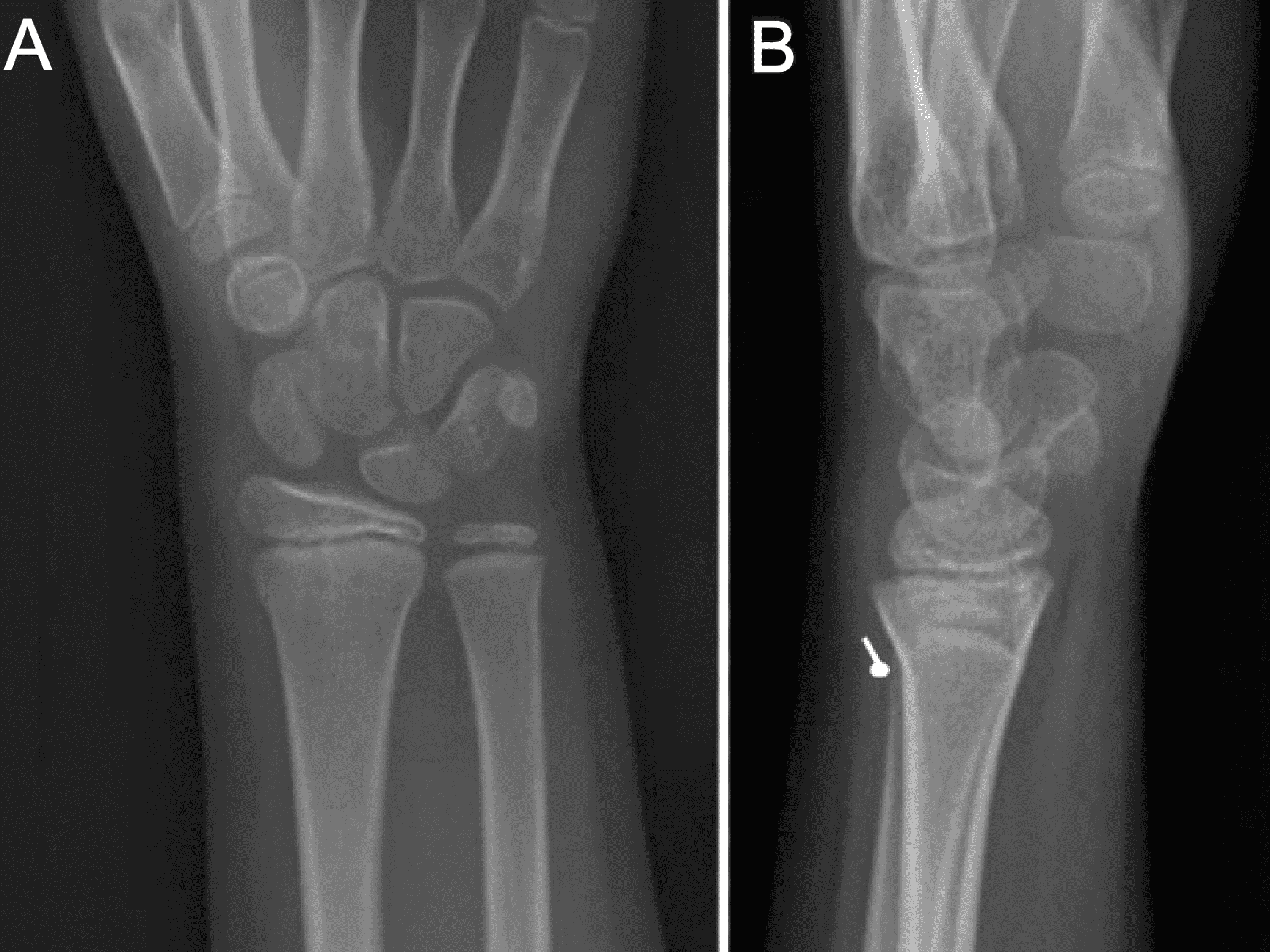 Cureus A Review of Pediatric Distal Radius Buckle Fractures and the