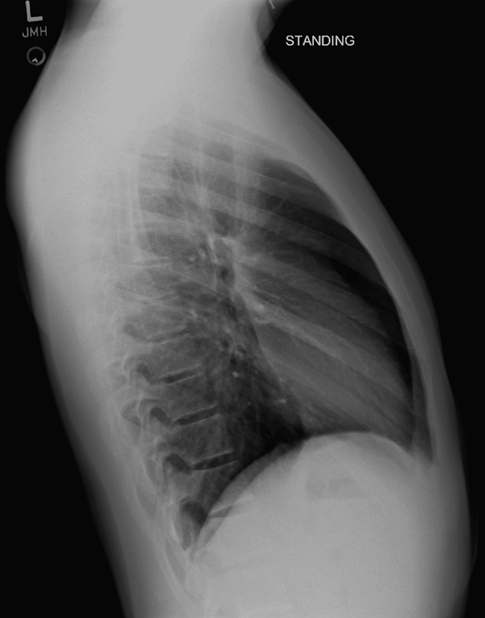 Lateral-chest-X-ray:-one-week-follow-up