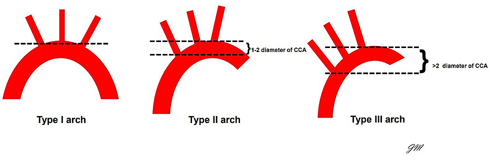 Turtleheading the Tough Aortic Necks! A Novel Endovascular Method to ...