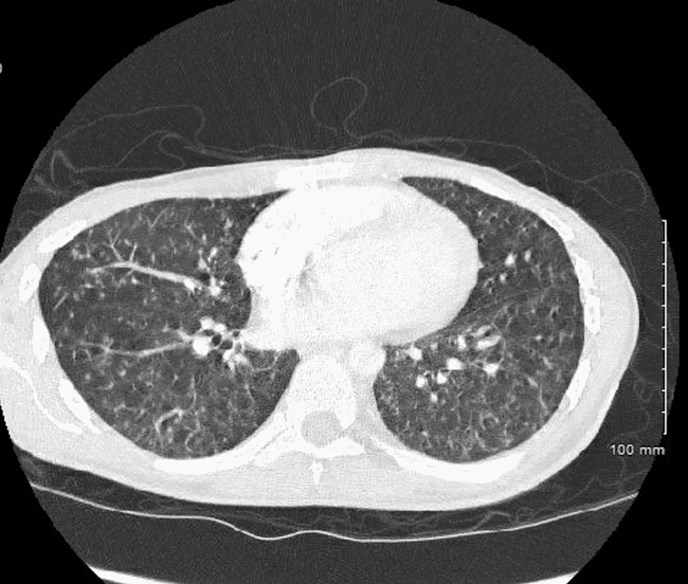 Miliary-pulmonary-nodules-consistent-with-tuberculosis.