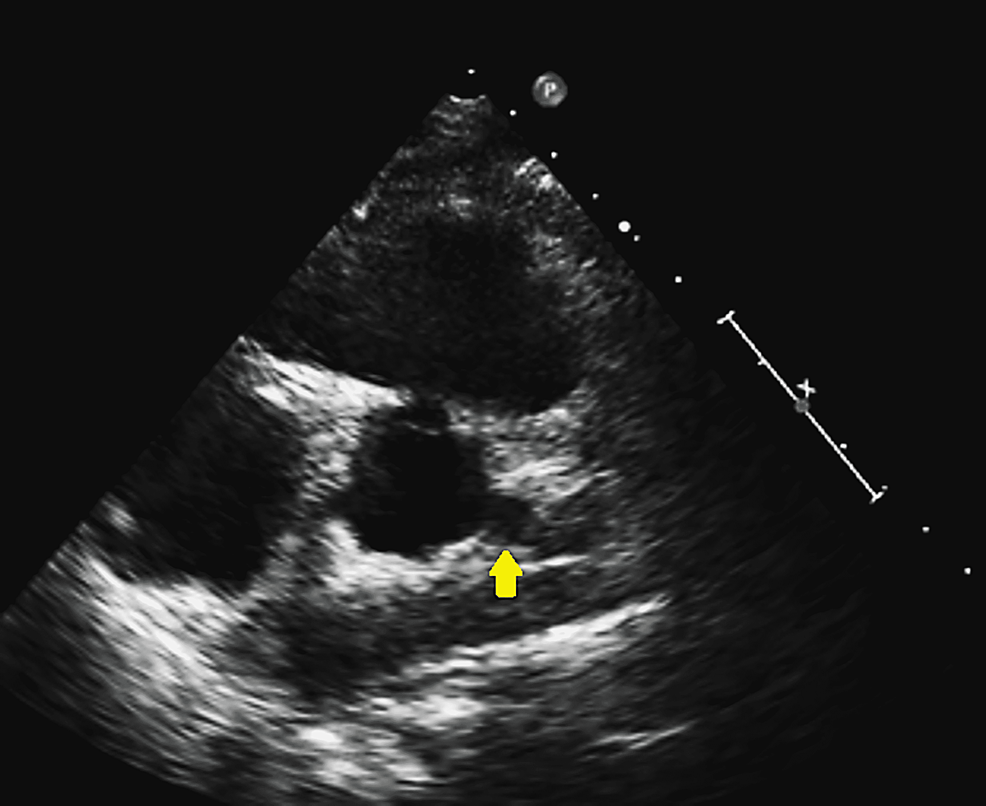 Echocardiogram-showing-a-possible-left-main-aneurysm.
