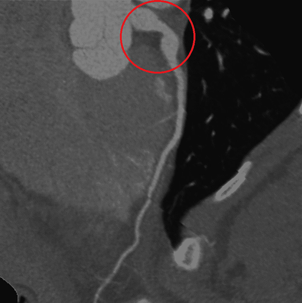 CTA-coronaries-show-the-aortic-root-and-the-left-coronary-aneurysm.