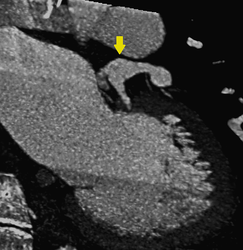 CTA-coronaries-showing-the-ventriculogram-and-the-left-coronary-fusiform-aneurysm.