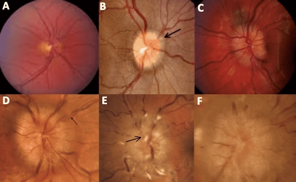 cureus-optic-disc-edema-and-elevated-intracranial-pressure-icp-a