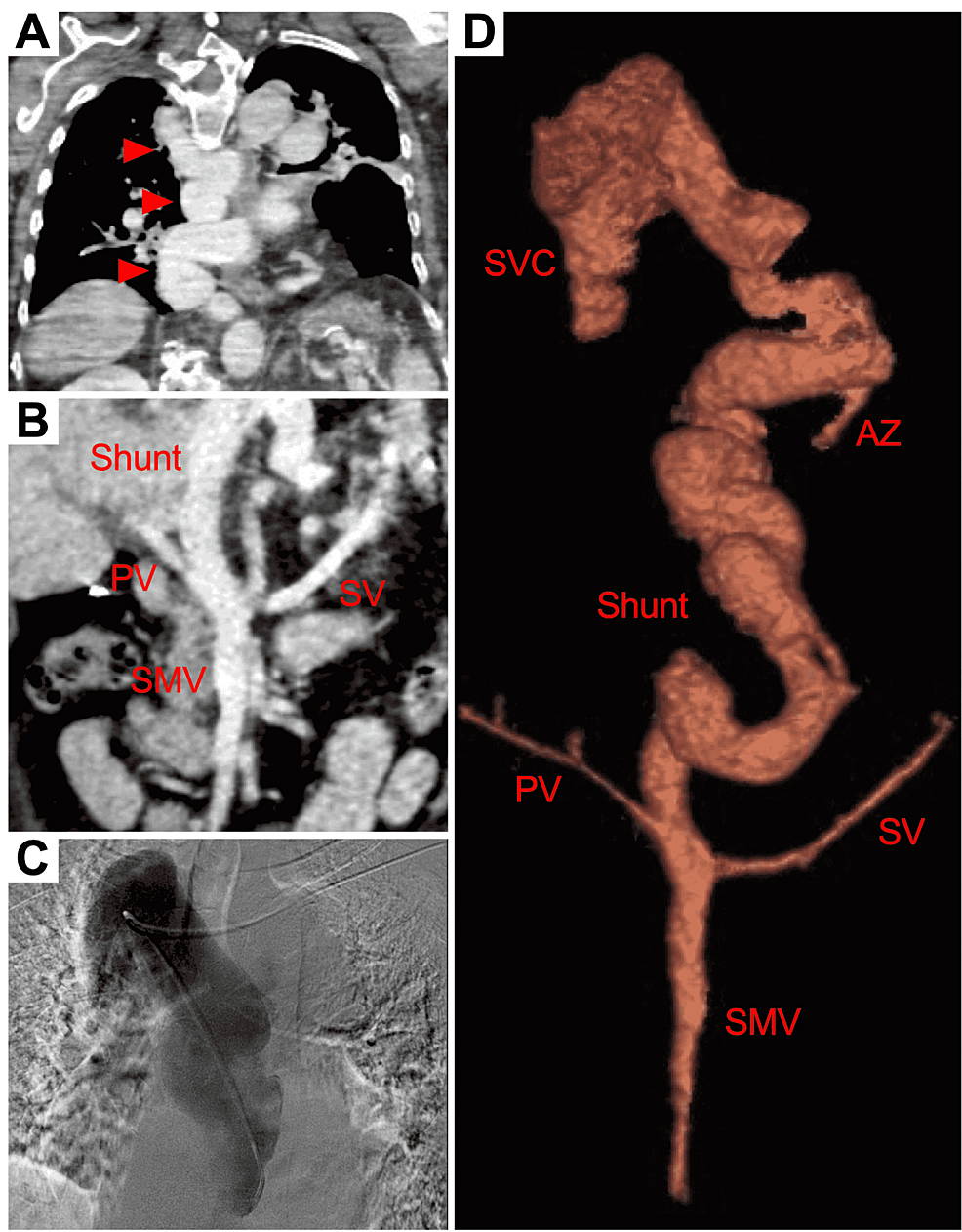 Cureus Congenital PortoAzygous Shunt Malformation Type II