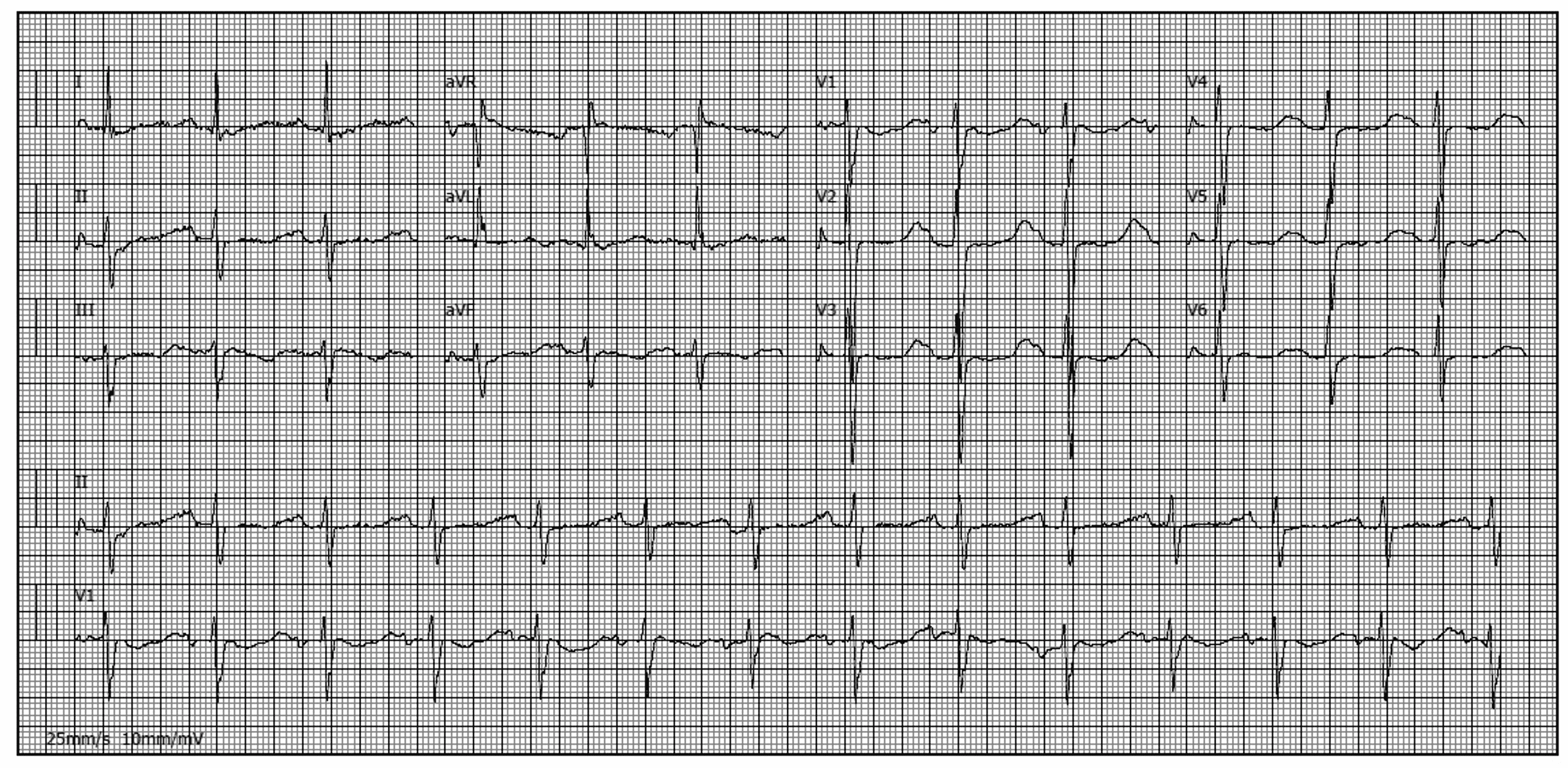 Cureus | Conn’s Syndrome: An Unusual Cause of Periodic Paralysis