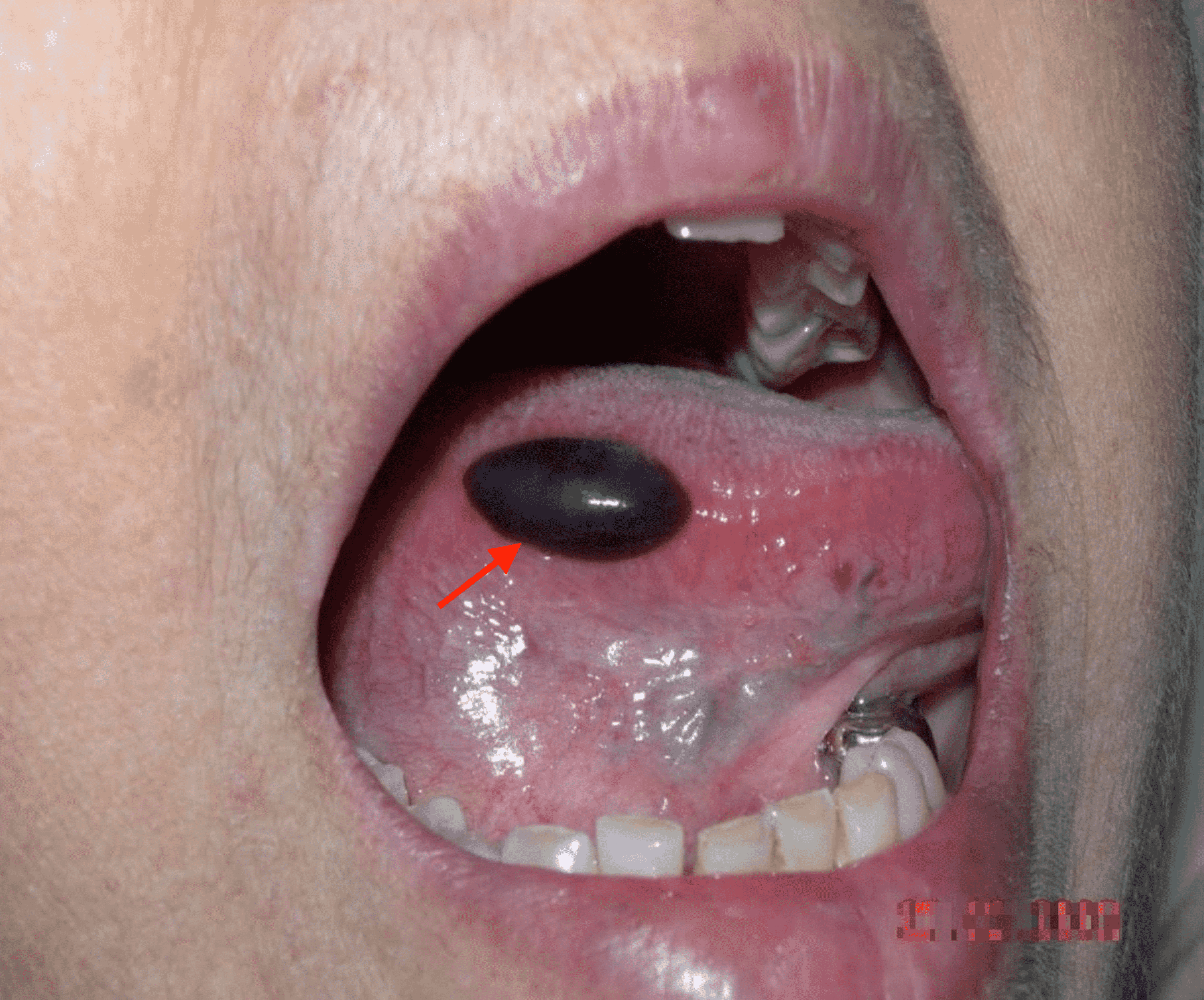 Blood Blister In Mouth