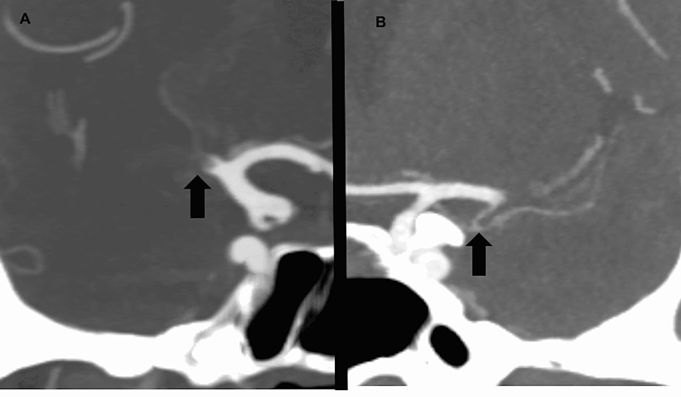 Coronal-CT-angiography-example-of-the-presence-and-absence-of-the-anterior-temporal-artery