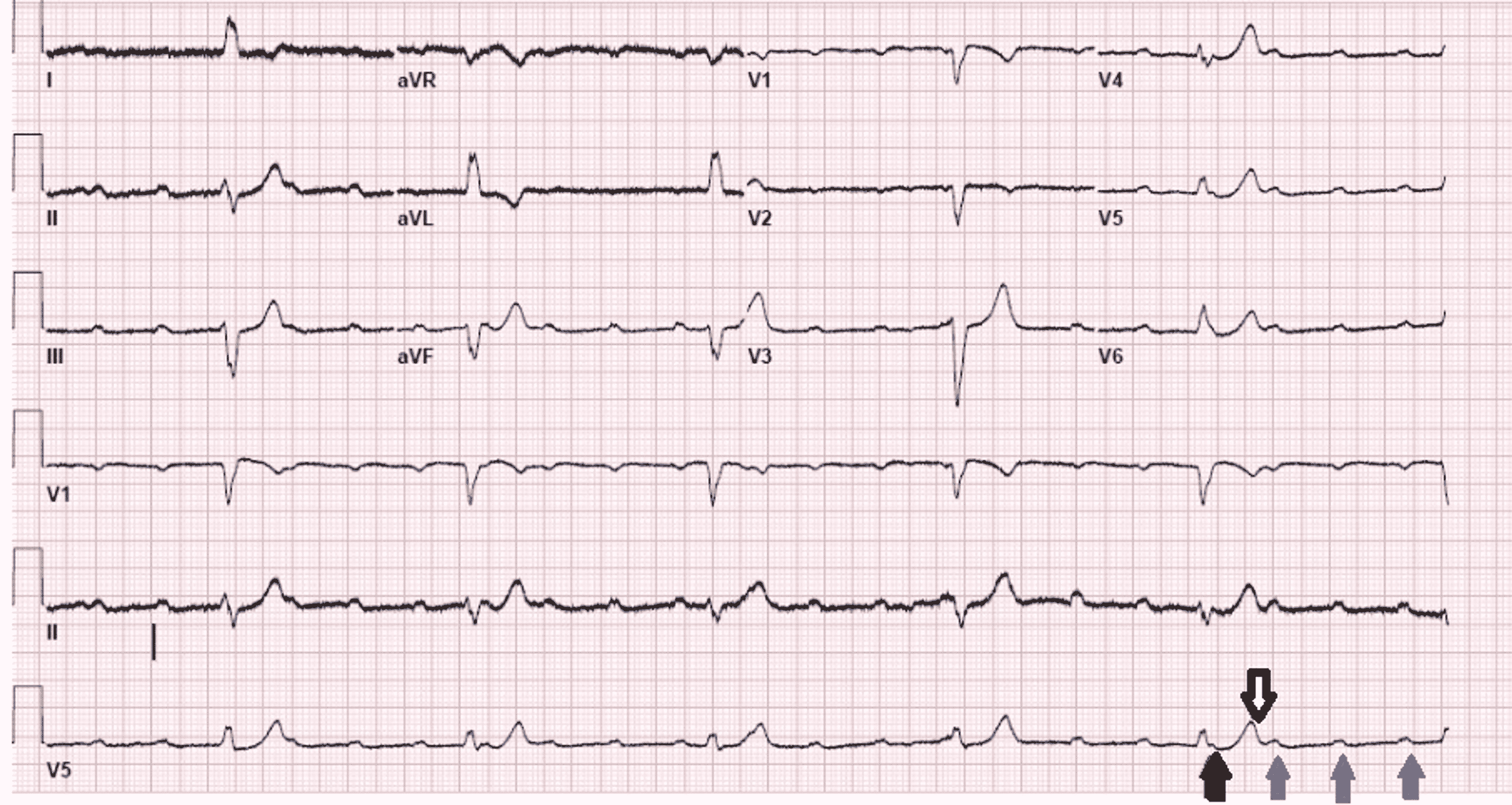 Cureus | Catastrophic Events of Cardiac Sarcoidosis: A Case Report