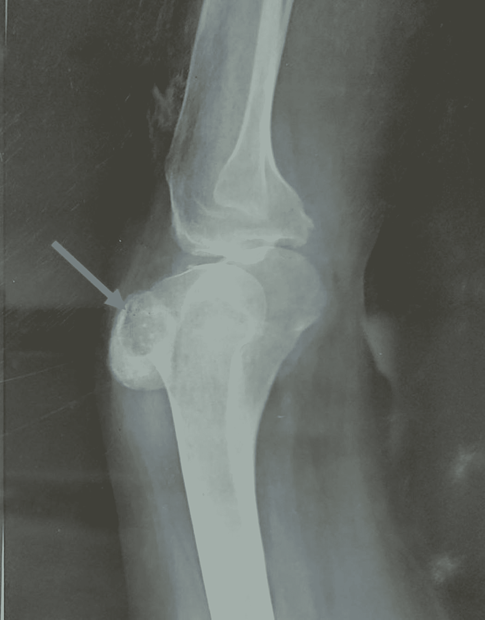 Lateral-X-ray-of-the-knee-demonstrating-localized-lytic-lesion-in-the-patella-with-soft-tissue-swelling-overlying.