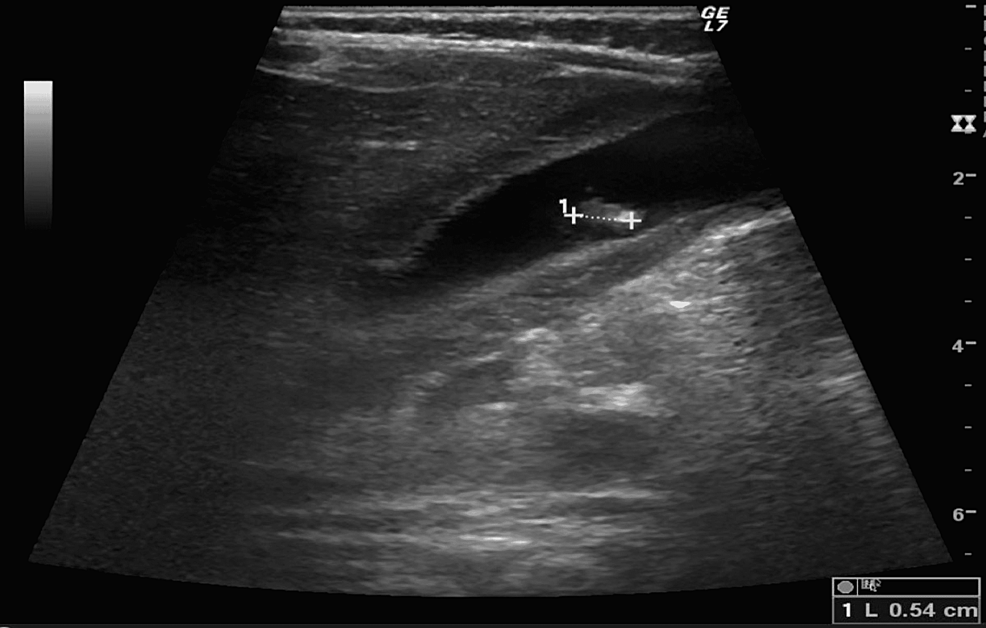 cureus-acute-calculous-cholecystitis-presenting-as-an-acute-abdomen