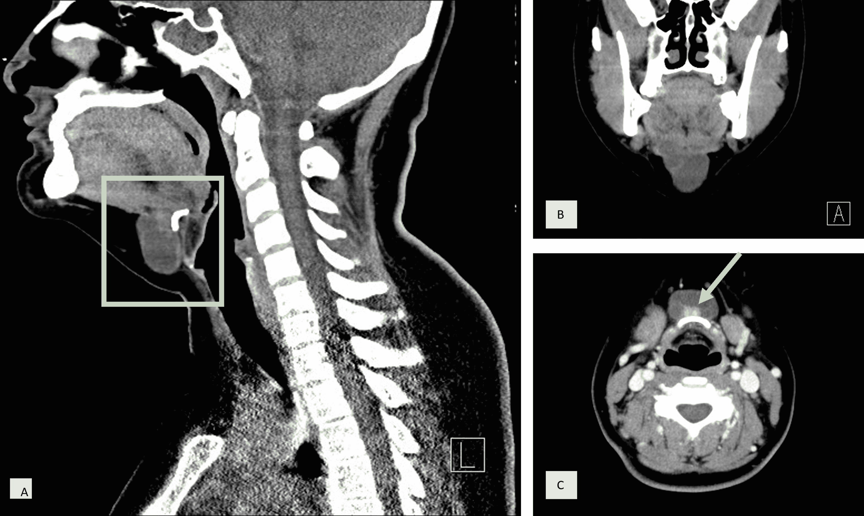 Cureus | Thyroglossal Duct Cyst Carcinoma With Synchronous Thyroid ...