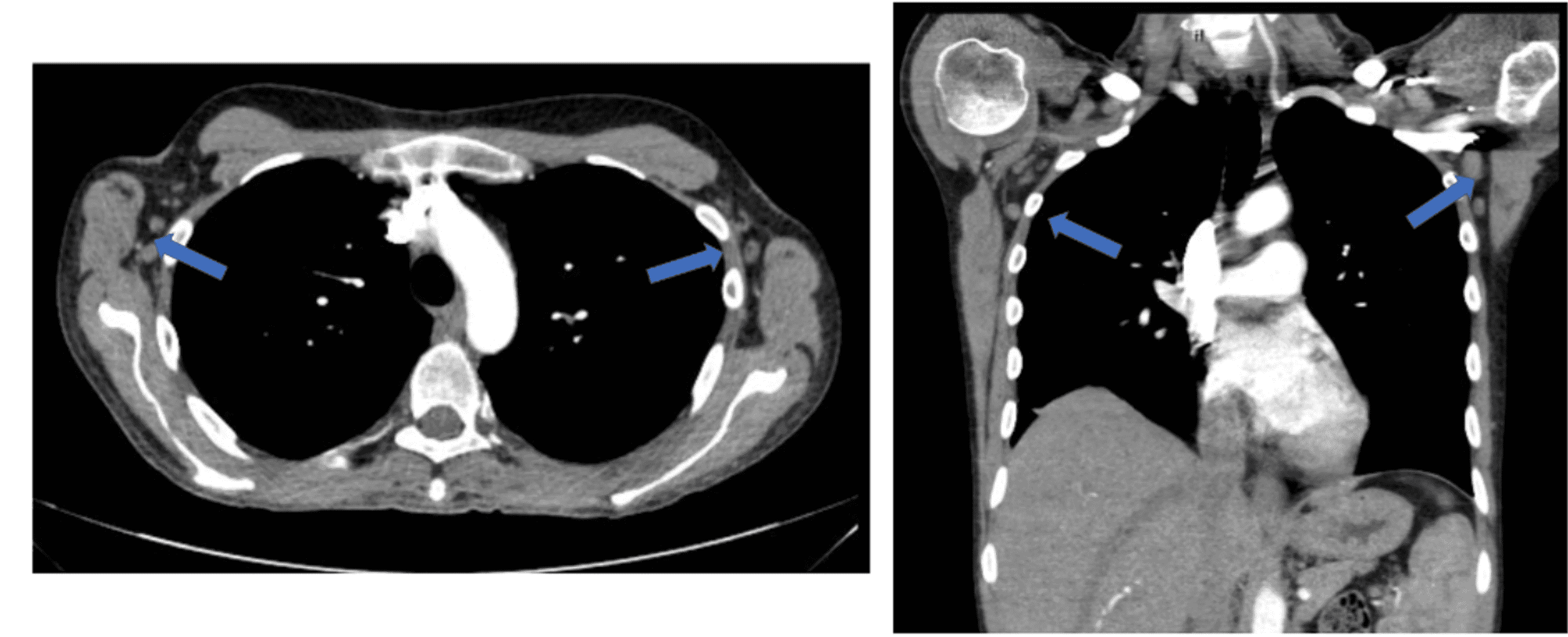 Cureus Methotrexate Failure in the Treatment of AdultOnset Still’s