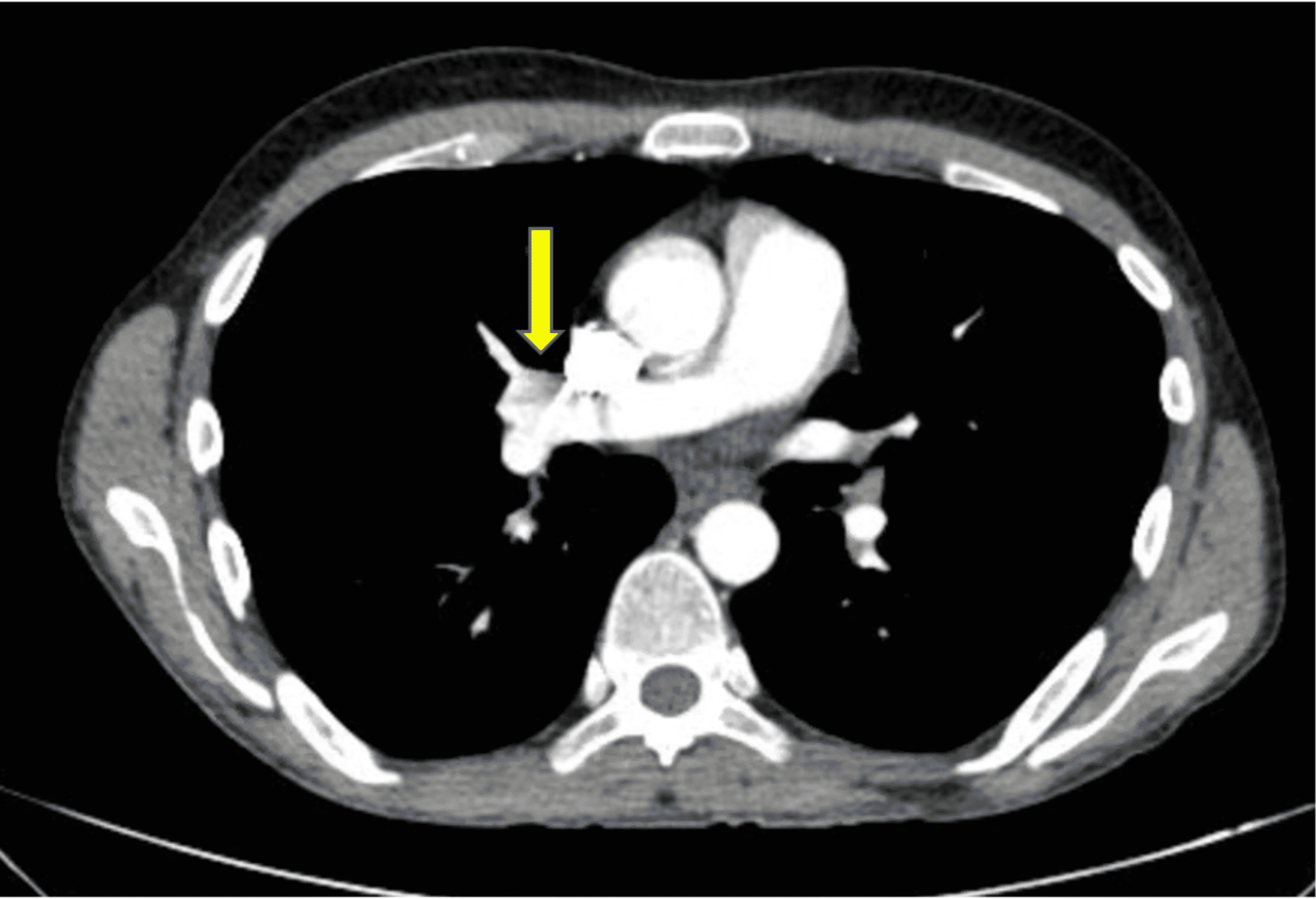 Cureus Methotrexate Failure in the Treatment of AdultOnset Still’s