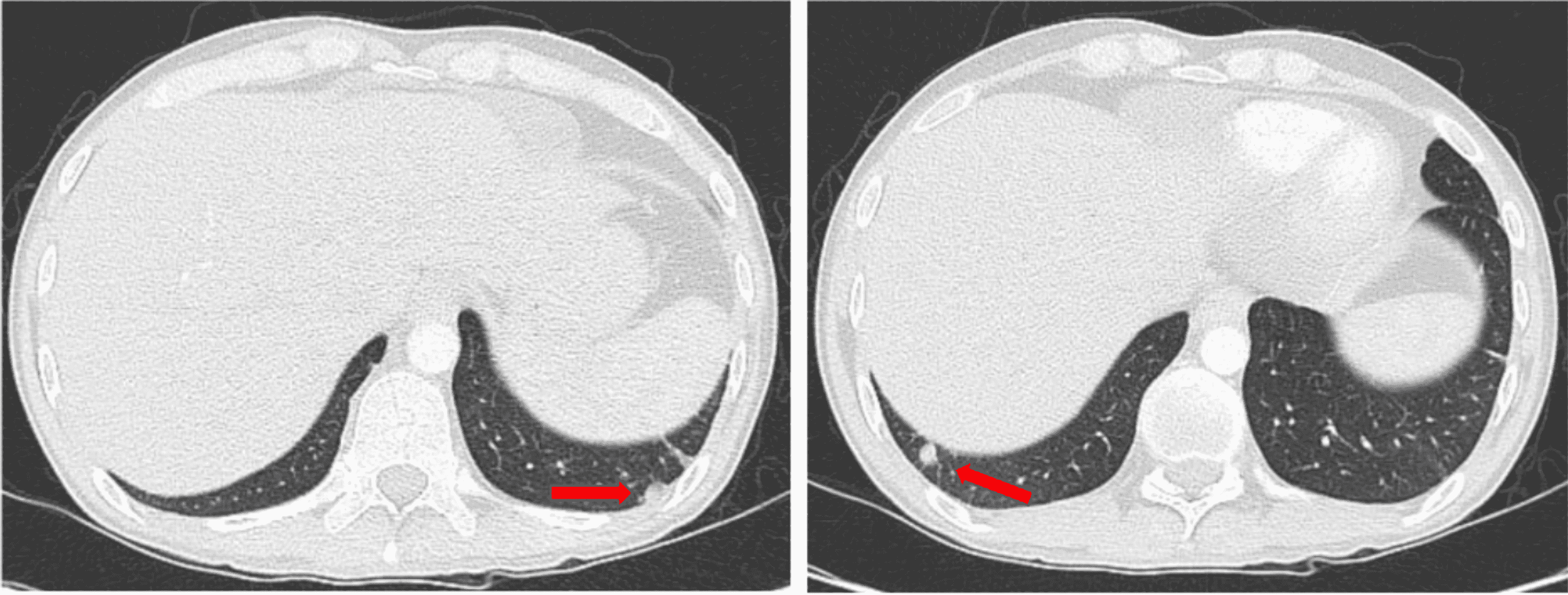 Methotrexate Failure in the Treatment of AdultOnset Still’s Disease A