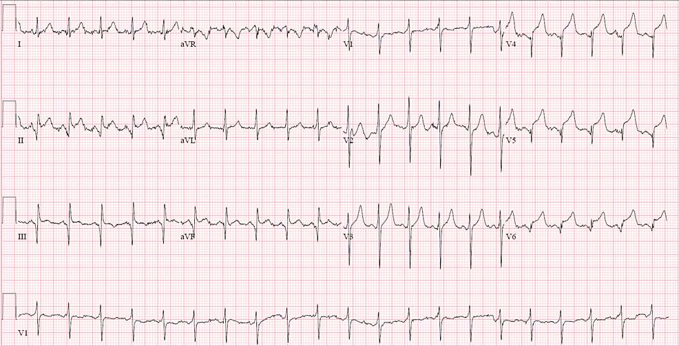 Cureus | COVID-19 Infection: A Sparked Ignition to a Thrombotic Storm