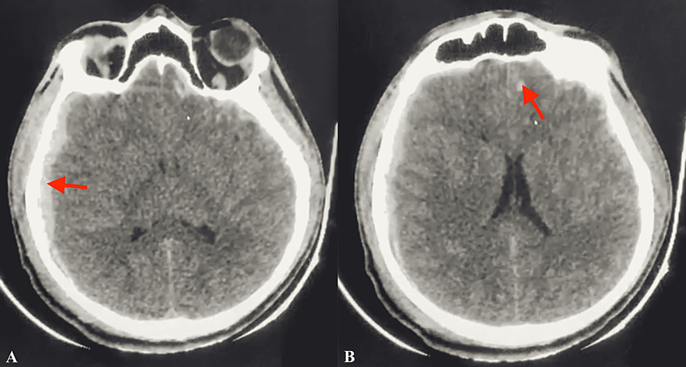 PDF) Microhemorrhage Pathology in Traumatic Brain Injury (TBI): Clinical  and Radiologic Features