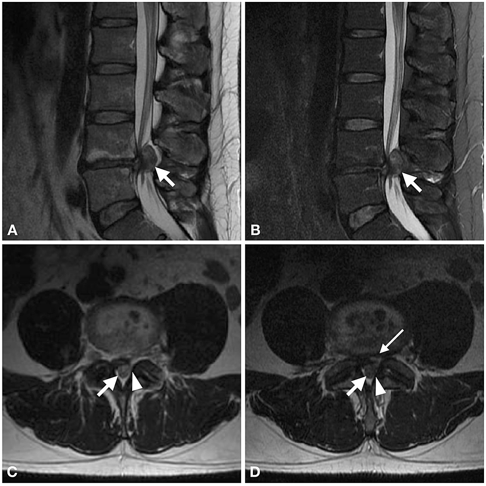 Cureus Posterior Epidural Migration Of A Lumbar Disc Herniation Causing Cauda Equina Syndrome 0226