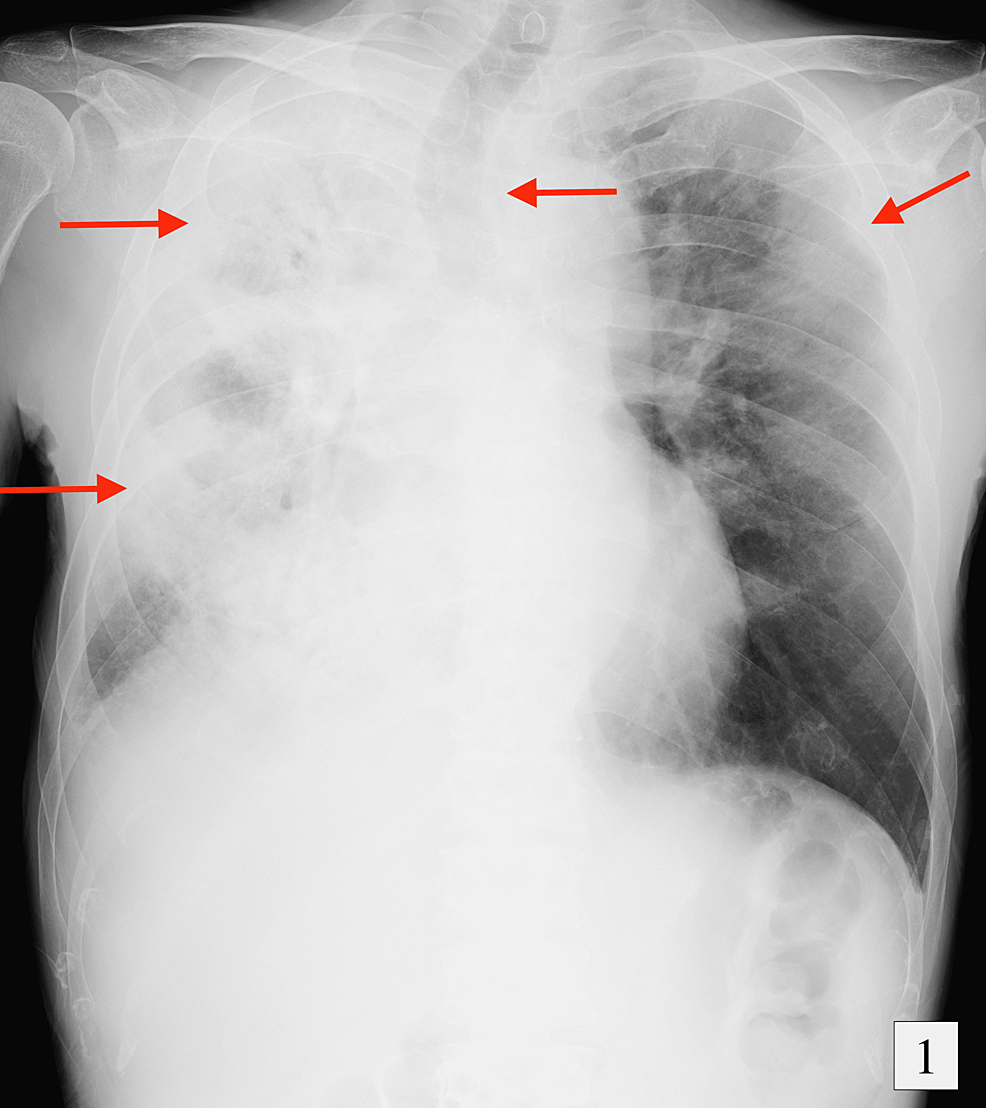 Cureus | Exacerbation of Eosinophilic Granulomatosis With Polyangiitis ...