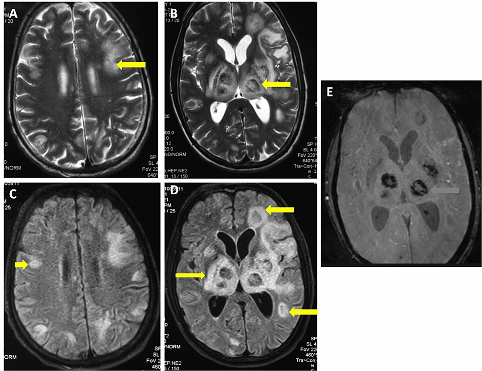 Cureus, Hemorrhagic Lesions in the Central Nervous System: Toxoplasmosis  in a Person Living With Human Immunodeficiency Virus Infection and Acquired  Immunodeficiency Syndrome